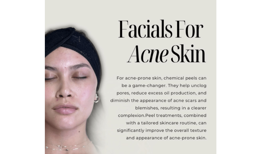 <p style="font-family: 'Poppins', sans-serif; font-weight: 700; font-size:24px;">ANTI-ACNE FACIALS</p>
